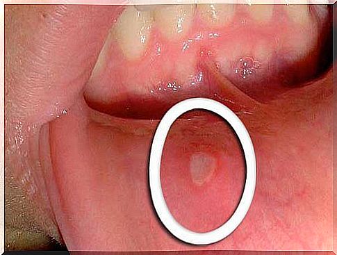 mouth ulcers