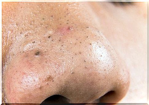 5 home remedies for blackheads