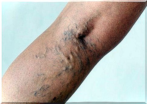 varicose veins