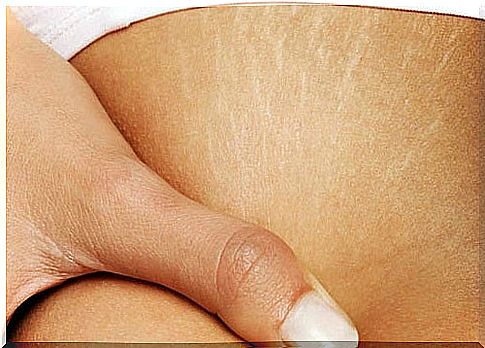 Can stretch marks be removed?