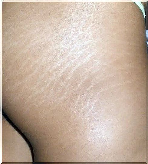 2stretch marks