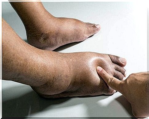 Swollen feet caused by fluid retention