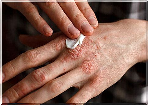 Five herbal treatments for psoriasis