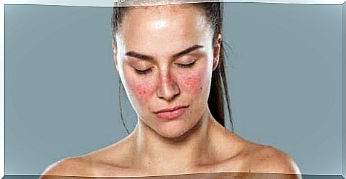 A woman suffering from lupus.