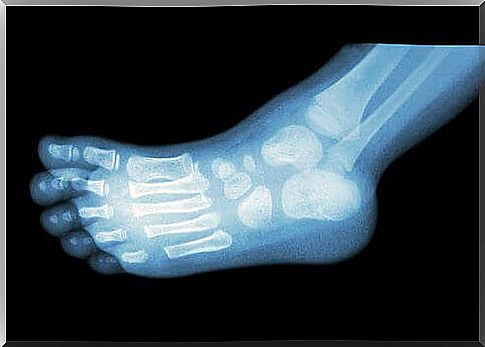 X-ray of foot