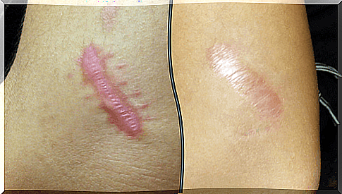 Reduce the visibility of scars in a natural way