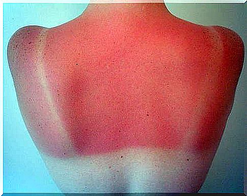 Seven remedies to prevent and cure sunburn