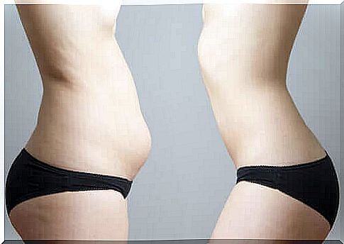 Before and after cryolipolysis