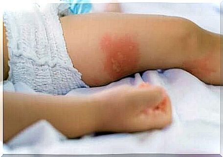 A baby with hives.